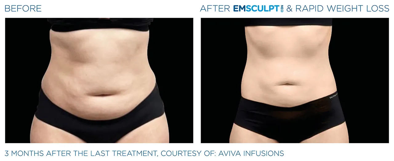 Before Image - Abdomen