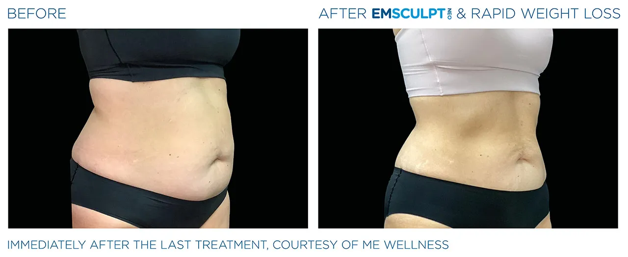 After Image - Abdomen